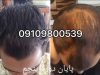 محلول دکتر نوروزیان برای جلوگیری از ریزش مو