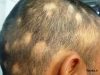 کچلی سکه ای چگونه درمان می شود