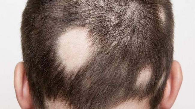 علت ریزش مو در مردان جوان