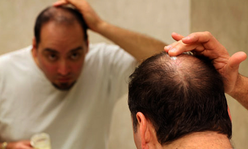 6 عامل مهم ریزش مو در آقایان