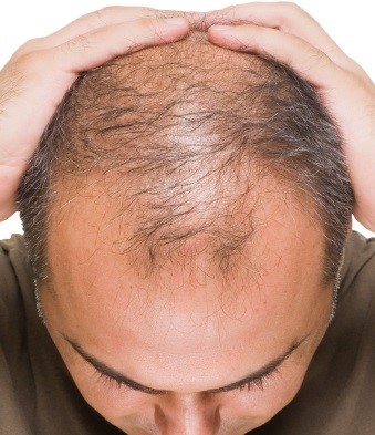 در خانه ریزش موی خود را درمان کنید