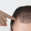 ارزانترین راه درمان ریزش مو